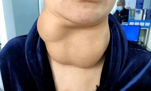 甲状腺单侧肿大图片,病因分析及诊断要点