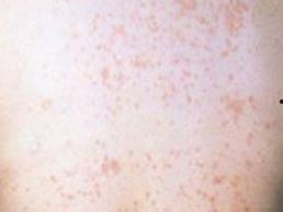 螨虫皮炎症状图片,识别与预防