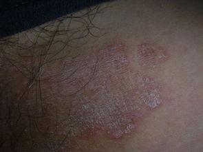 红斑是什么样的图片