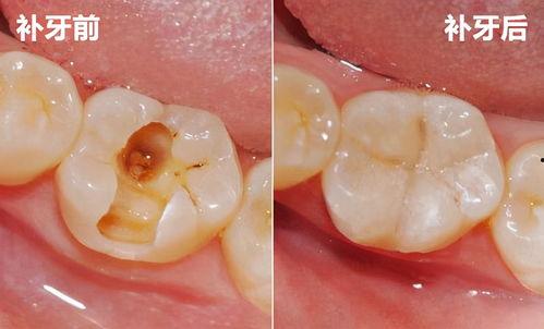 牙漏图片大全,揭秘牙齿问题背后的真相