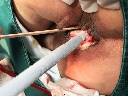 肛门纤维瘤图片,形态与特征解析