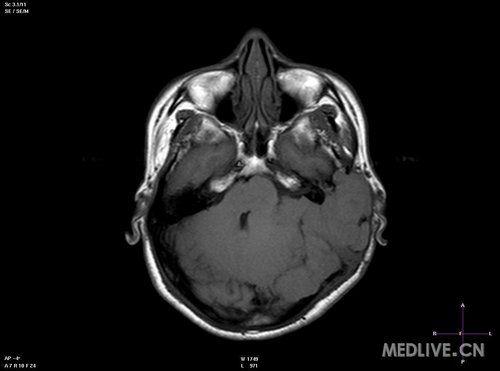 肛门纤维瘤图片,形态与特征解析