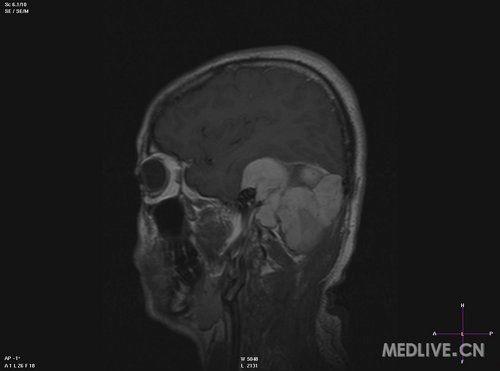 肛门纤维瘤图片,形态与特征解析