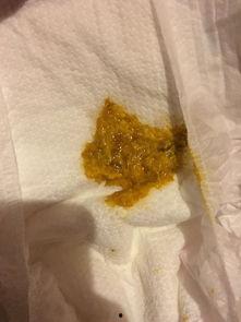 乳糖不耐受的大便图片,乳糖不耐受大便特征解析