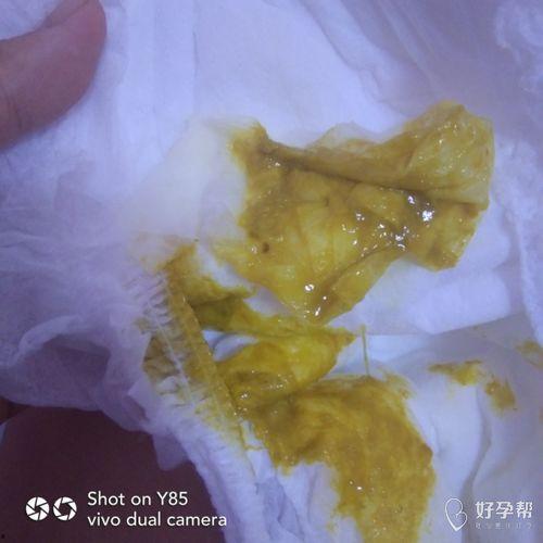 乳糖不耐受的大便图片,乳糖不耐受大便特征解析